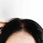 女性のための”薄毛治療”があります！